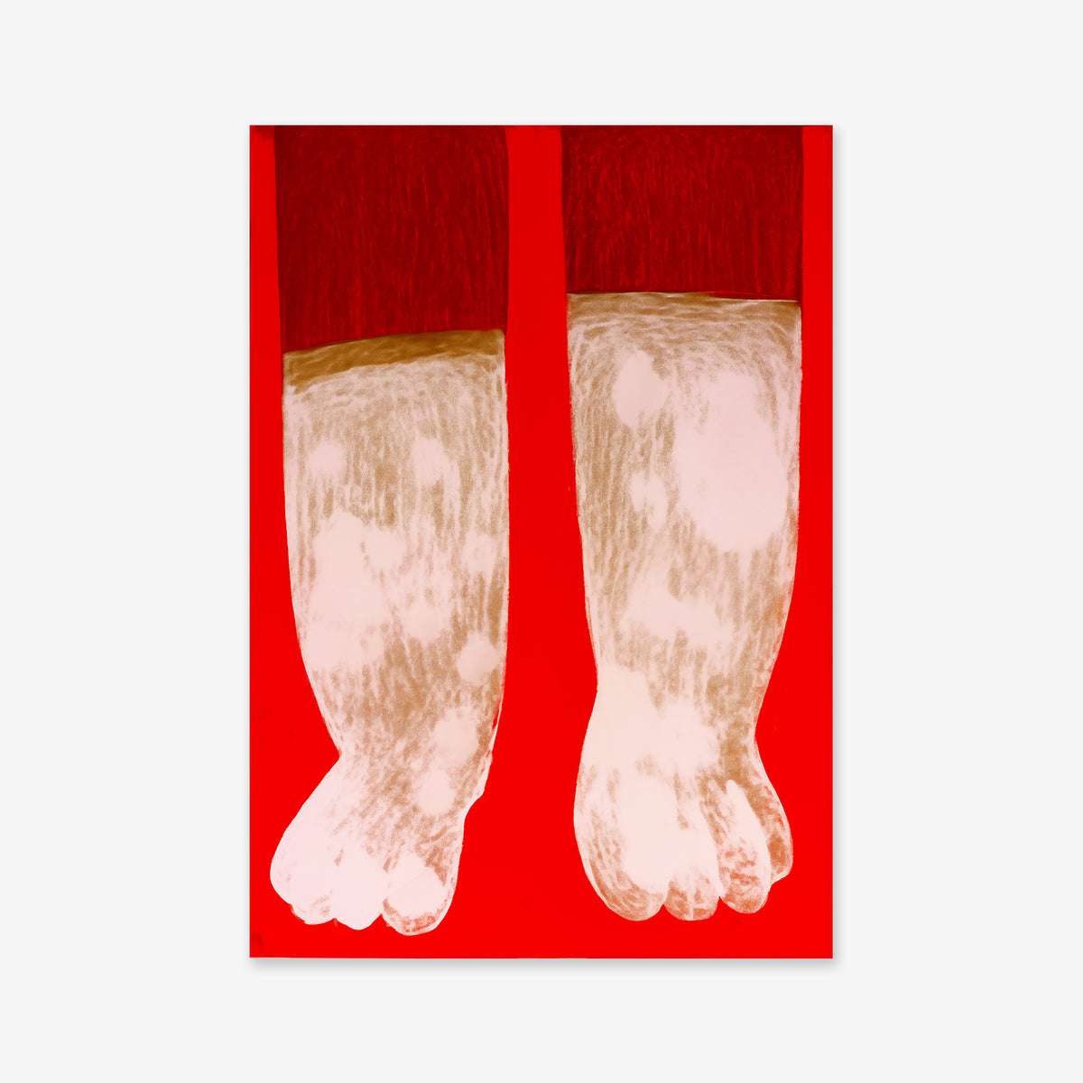 An illustration of two lower legs and feet featuring visible skin discoloration in red, pink, and white shades against a bright red background—ideal as a giclée art print to complement modern interiors, inspired by the theme of toe socks.